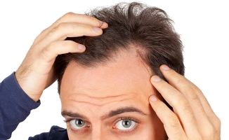 Bu soru hep gündemde! Erkeklerde Genetik Saç Dökülmesi Nasıl Önlenir?