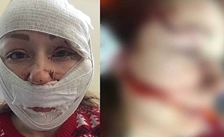 Boşanmak isteyen Ukraynalı eşinin yüzünü falçatayla kesen sanık tahliye edildi 