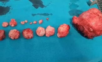 Şok eden görüntü: Rahminden 16 tümör çıkartıldı